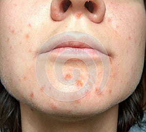 Coxsackie virus rash face photo